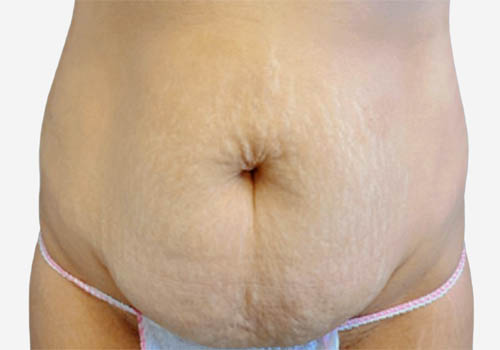 Tummy Tuck Case 4187 Before Photo Tummy Tuck