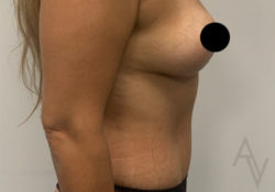 Tummy Tuck