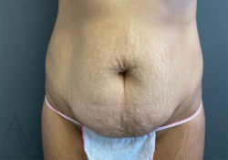 Tummy Tuck