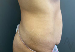 Tummy Tuck