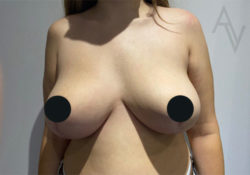 Breast Reduction