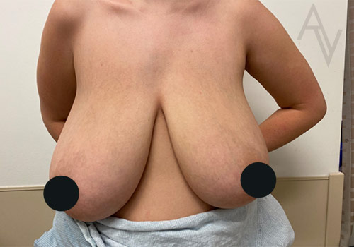 Breast Reduction Case 4867 Before Photo Breast Reduction