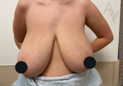 Breast Lift