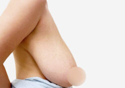 Breast Lift