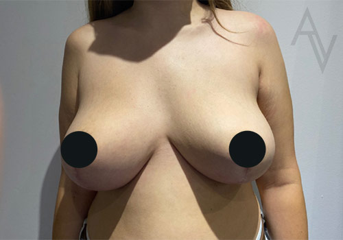 Breast Lift Case 4872 After Photo Breast Lift