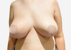 Breast Lift