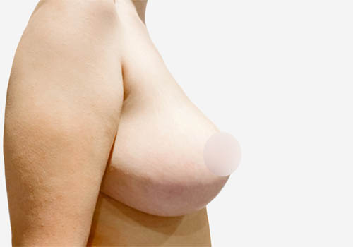 Breast Lift