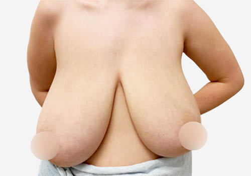 Breast Lift