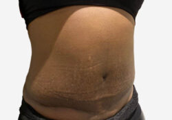 Tummy Tuck