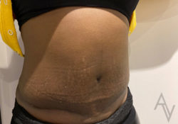 Tummy Tuck