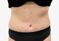 Tummy Tuck