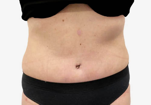 Tummy Tuck