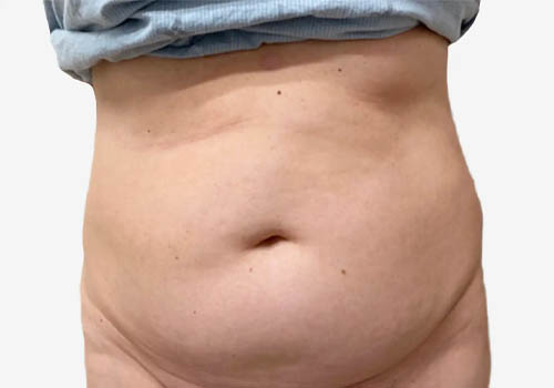 Tummy Tuck