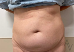 Tummy Tuck