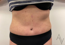 Tummy Tuck