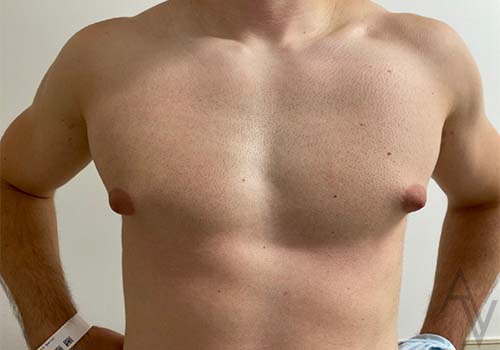 Male Breast Reduction