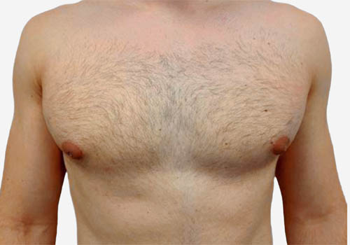 Male Breast Reduction