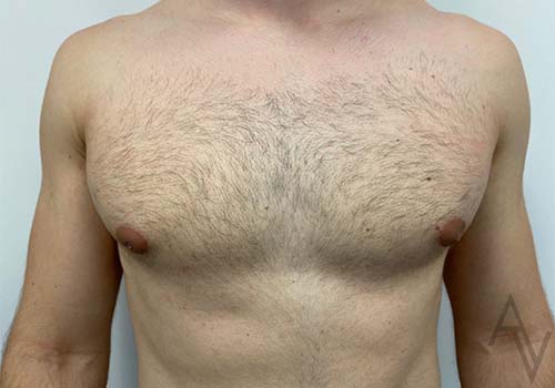 Male Breast Reduction