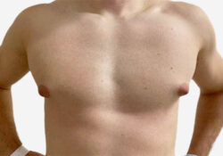 Male Breast Reduction