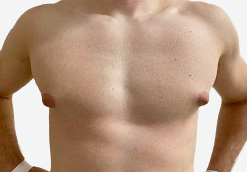 Male Breast Reduction