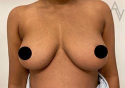 Breast Augmentation