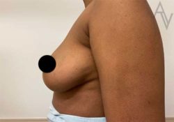 Breast Augmentation