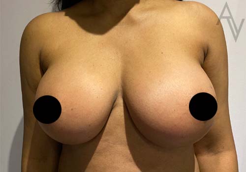 Breast Augmentation Case 5594 After Photo Breast Augmentation