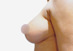 Breast Augmentation