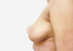 Breast Augmentation