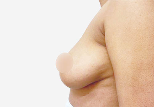 Breast Augmentation