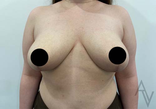 Breast Reduction Case 6541 After Photo Breast Reduction
