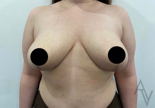 Breast Reduction