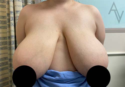 Breast Reduction Case 6541 Before Photo Breast Reduction