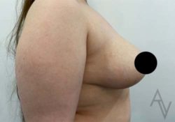 Breast Lift