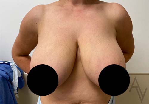 Breast Reduction