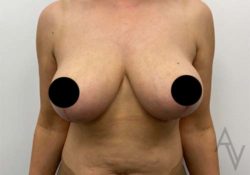 Breast Lift