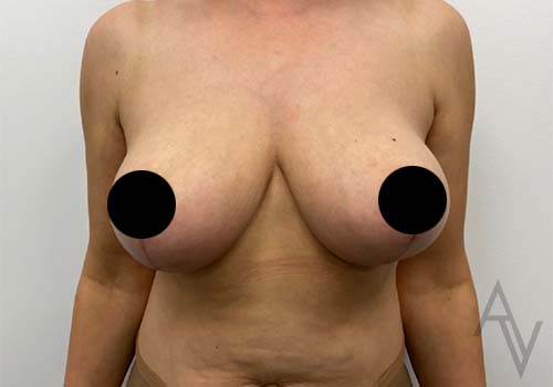Breast Lift Case 6556 After Photo Breast Lift
