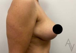 Breast Lift