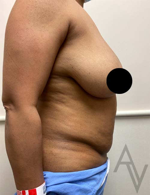 Breast Reduction