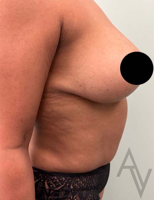 Breast Reduction