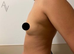 Breast Augmentation