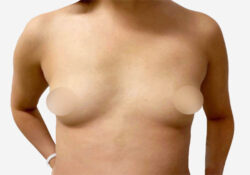 Breast Augmentation