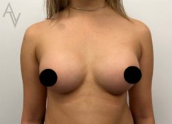 Breast Augmentation