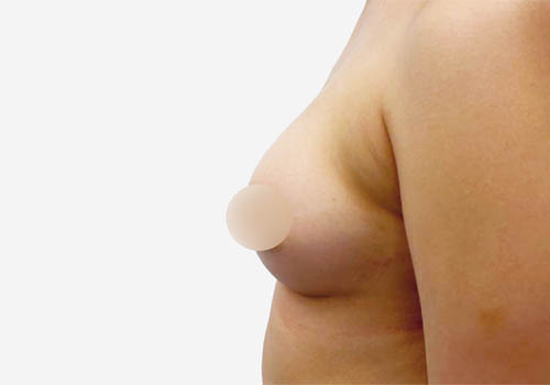 Breast Augmentation