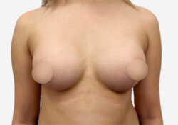 Breast Augmentation
