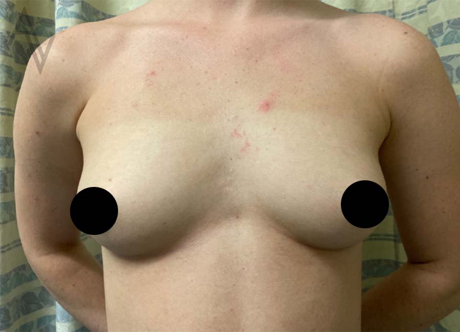 Breast Augmentation