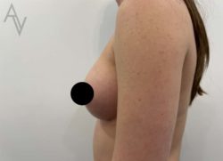 Breast Augmentation