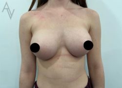 Breast Augmentation