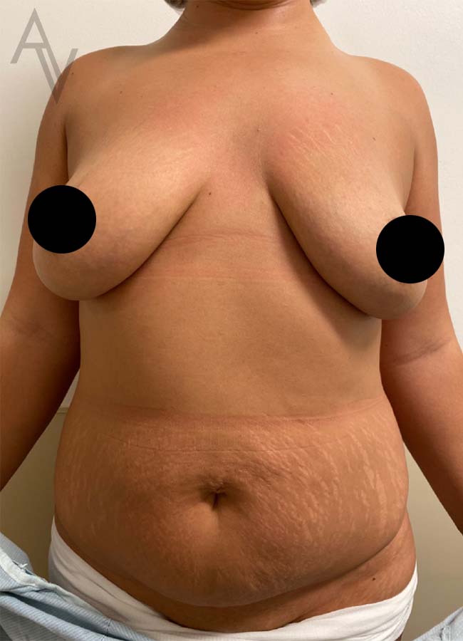 Mommy Makeover Case 7471 Before Photo Mommy Makeover