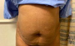 Tummy Tuck